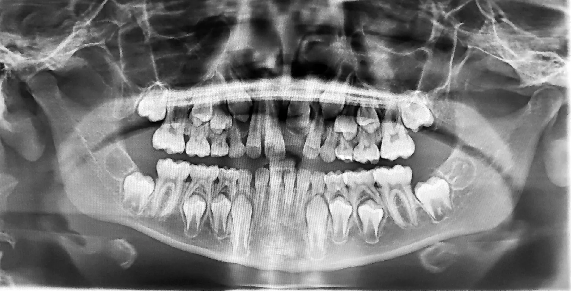 Panoramic dental X-ray of a child showing baby teeth and developing permanent teeth